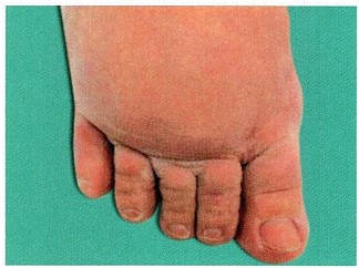 Chronic lymphedema Surgery Image based MCQ - NEET PG Past Papers - PART 14 NEET PG Exams