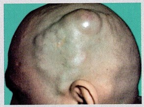 Cirsoid aneurysm Surgery Image based MCQ - NEET PG Past Papers - PART 14 NEET PG Exams