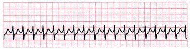 DC cardioversion Image based MCQ - NEET PG Past Papers - PART 15 NEET PG Exams