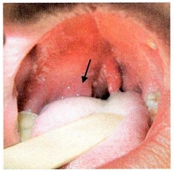 PeritonsiJlar abscess Image based MCQ - NEET PG Past Papers - PART 15 NEET PG Exams