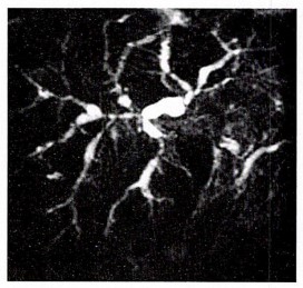 Primary sclerosing cholangitis Surgery Image based MCQ - NEET PG Past Papers - PART 14 NEET PG Exams