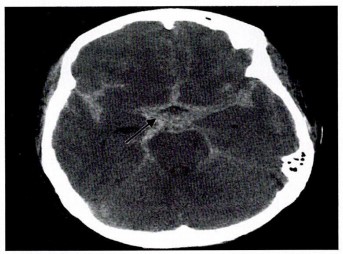 Subarachnoid hemorrhage Image based MCQ - NEET PG Past Papers - PART 15 NEET PG Exams