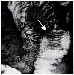 lntussusception Surgery Image based MCQ - NEET PG Past Papers - PART 14 NEET PG Exams